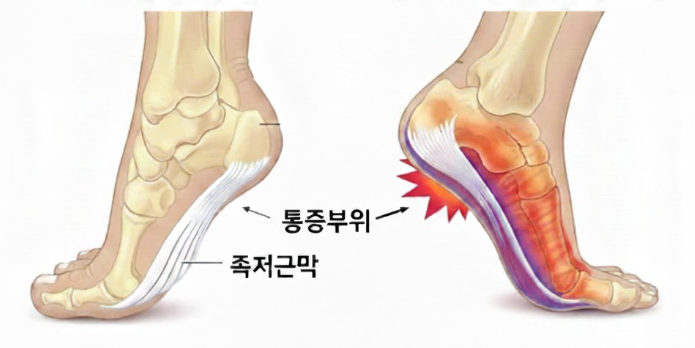 족저근막염 통증부위 설